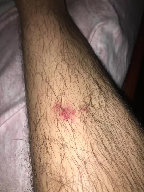 Does this looks like an Cellulitis infection ?