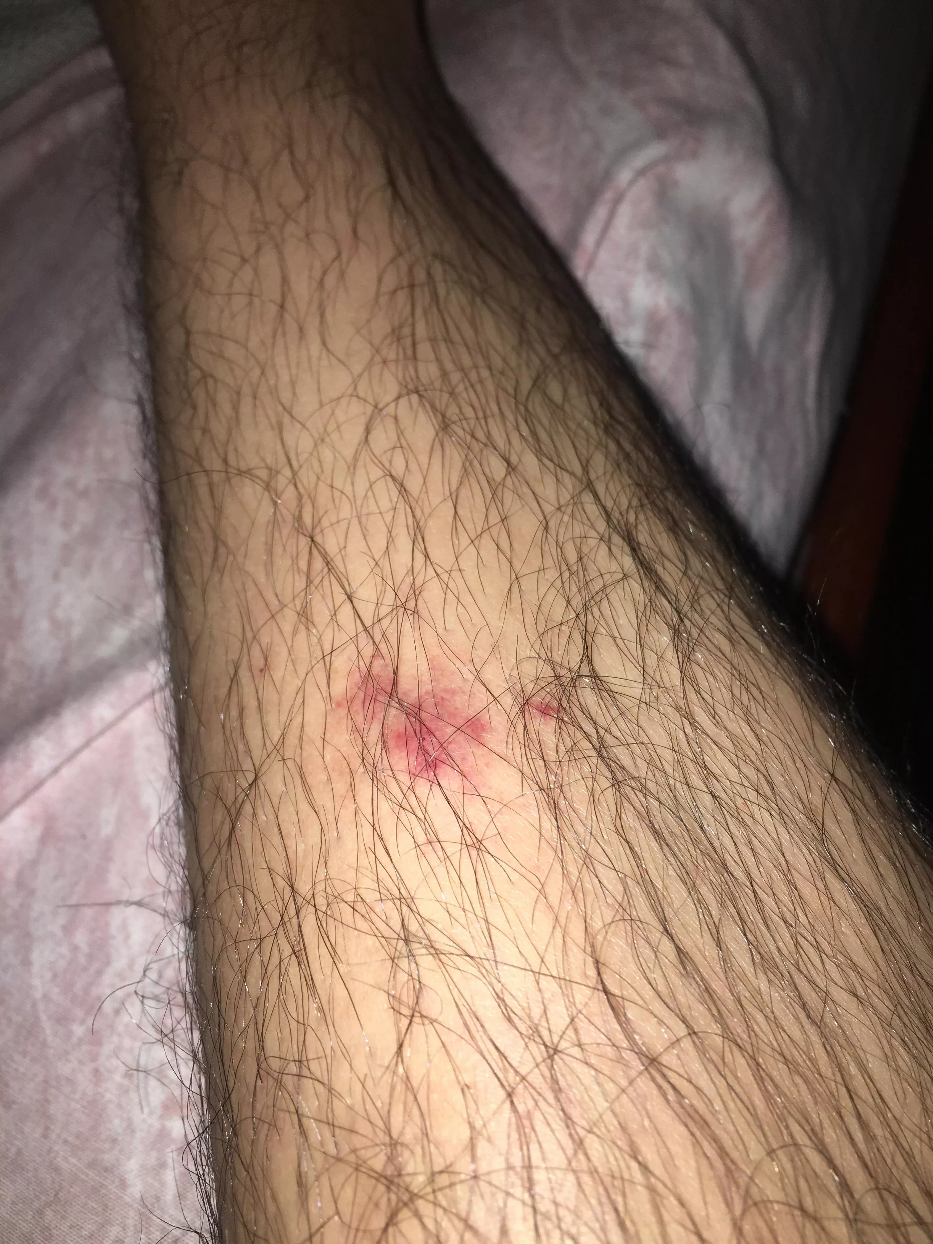 Does this looks like an Cellulitis infection ?