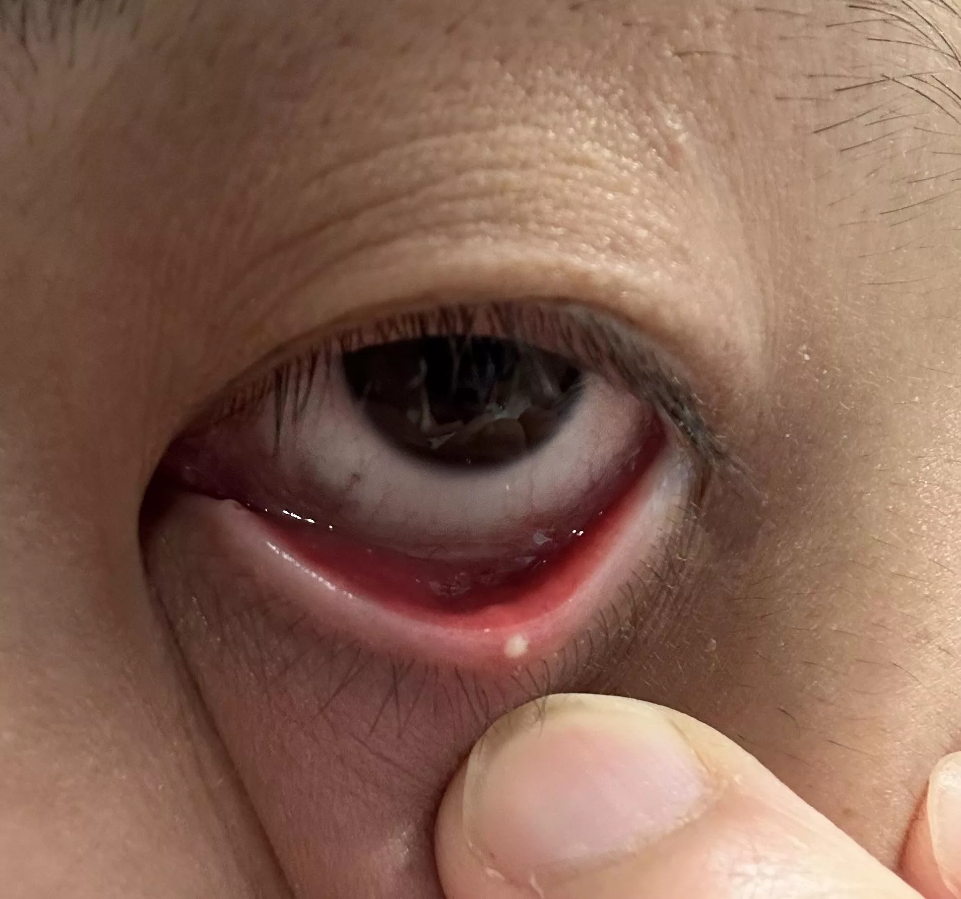 Forbidden pop? It’s a sty and it is just stuck there building pressure I’m very tempted to pop it but have to stop myself .