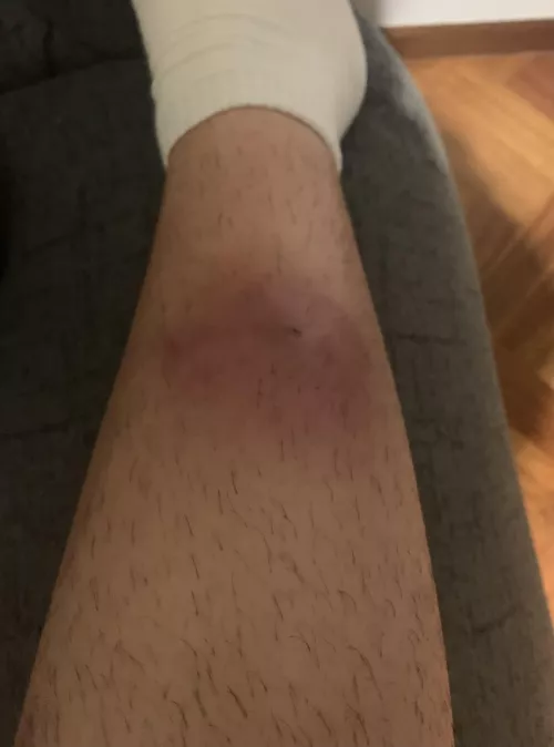 Forbidden pop. Some kind of bug bit me in the leg overnight and it got all infected and swollen like crazy. Doctor prescribed a week of antibiotics to try to reduce it a bit before cutting it open to drain it
