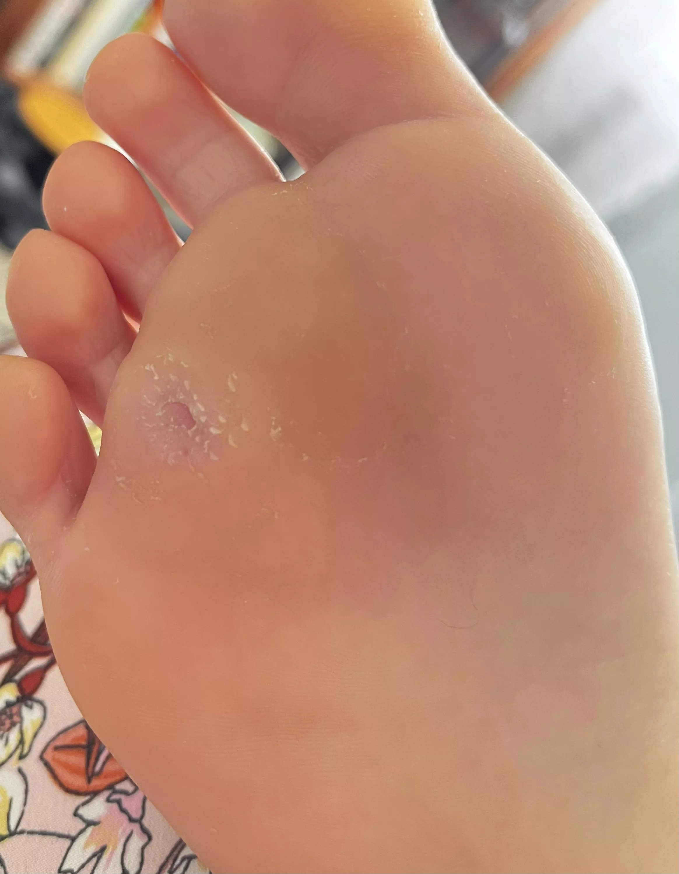 Is this plantar wart gone?