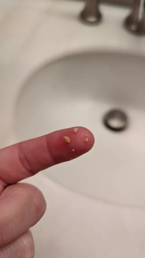 I couldn't sleep because I felt something in my throat. Turned into an excavation.