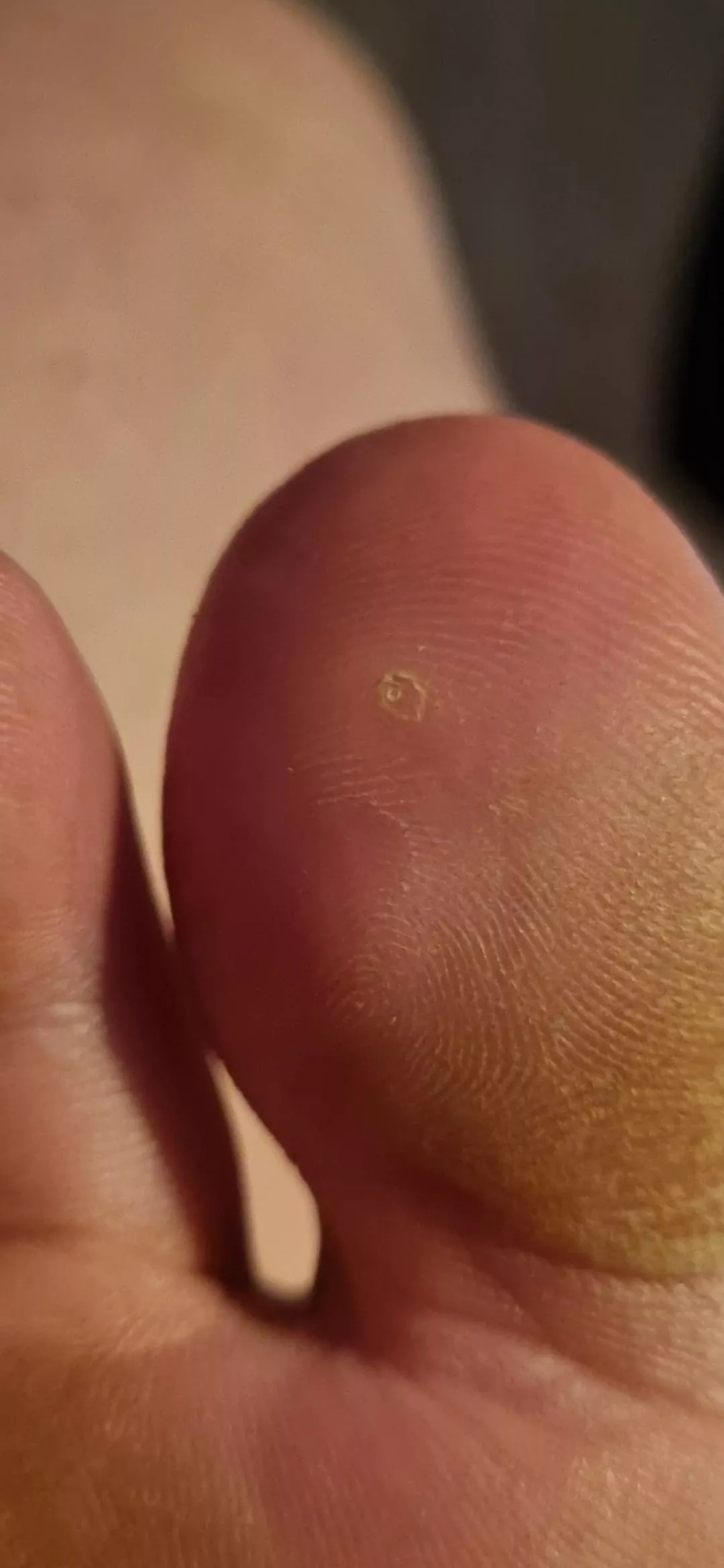 My toe has started bothering me, I thunk there's something stuck in there. Any ideas on the best way to get it out?