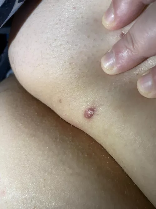 This is towards the top of my buttcheeks and hurts. What is it?