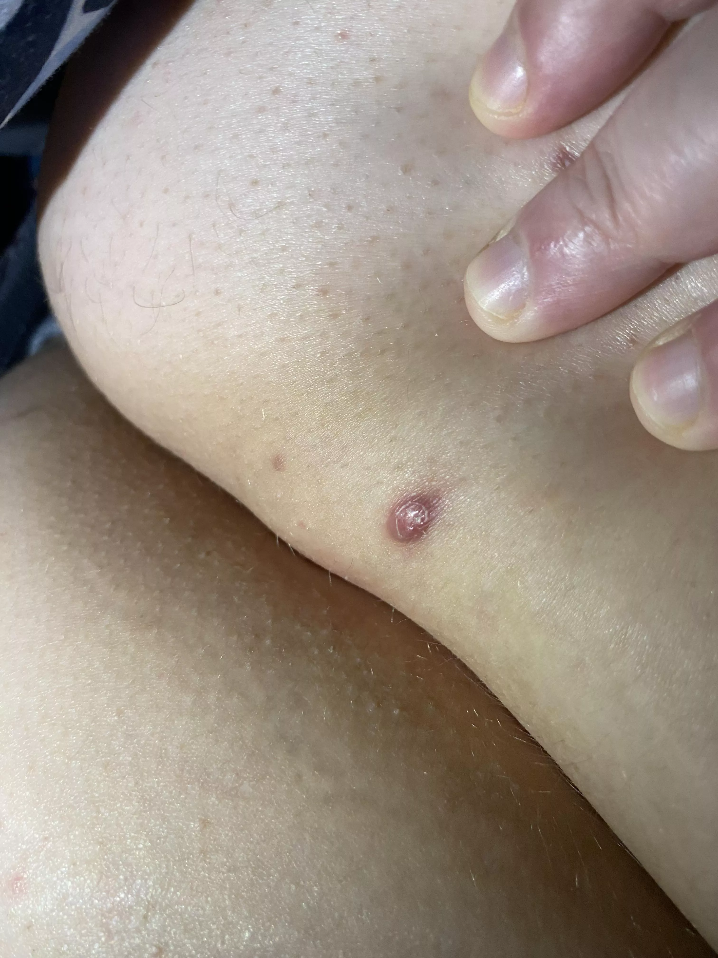 This is towards the top of my buttcheeks and hurts. What is it?