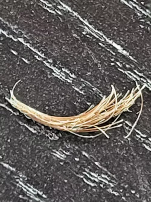 Compound Ingrown Eyelash 3 years in the making