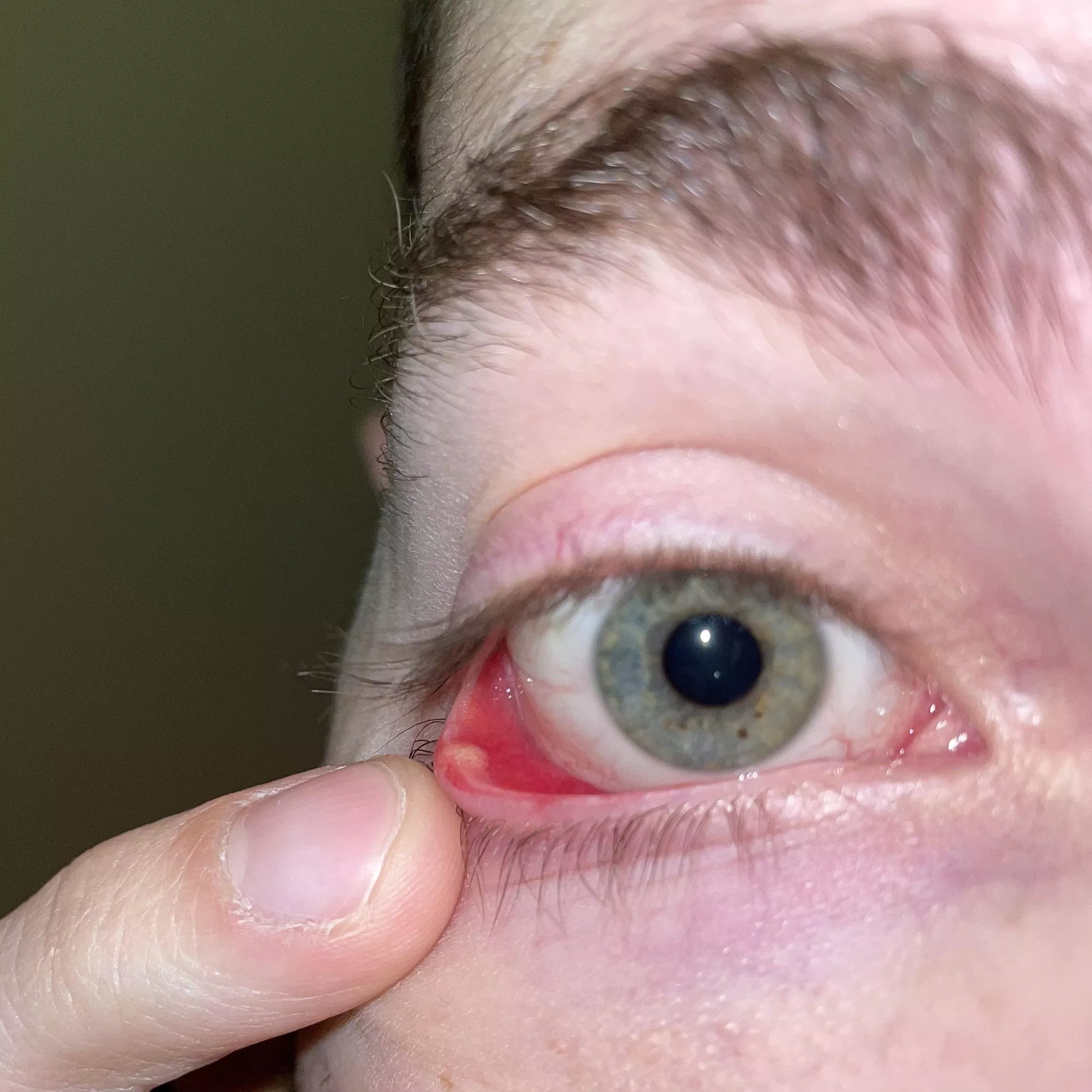 Internal Stye - ripping my eyelid off tomorrow if this thing isn’t gone by then