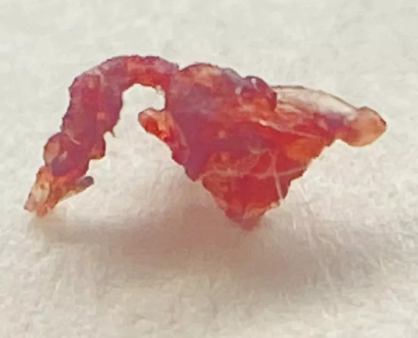 Cute little “teapot” lipoma