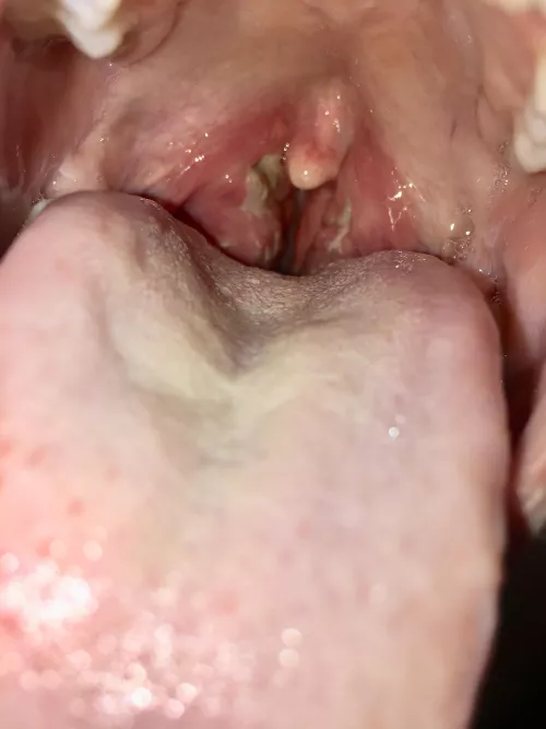 from when i had tonsillitis a few years ago! ended up having to get my tonsils out (warning gross)