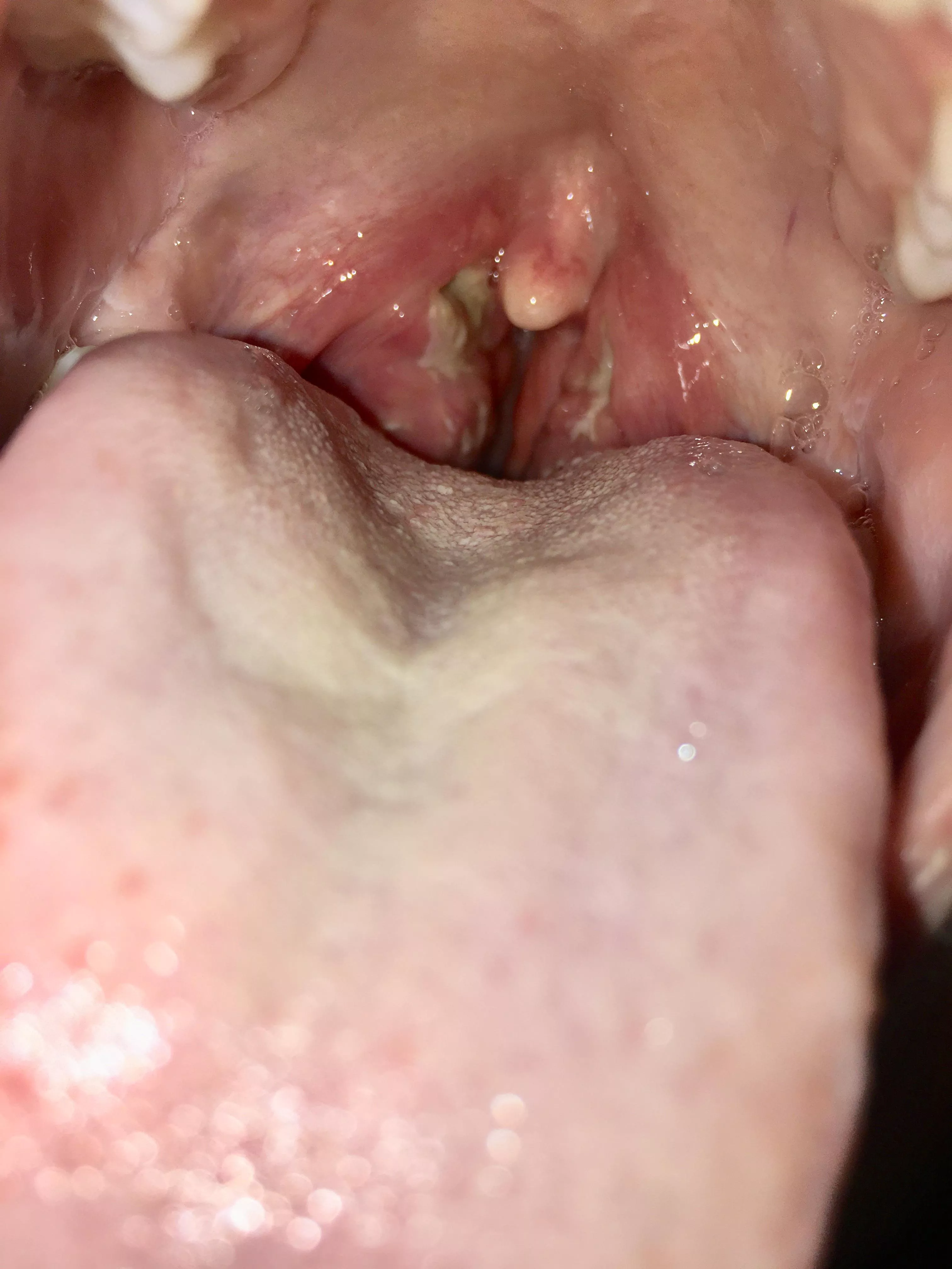 from when i had tonsillitis a few years ago! ended up having to get my tonsils out (warning gross)