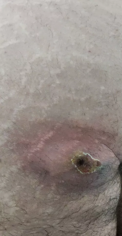 I think I have a cyst