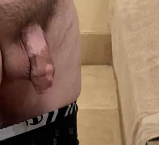 I have vitiligo. It’s harmless.