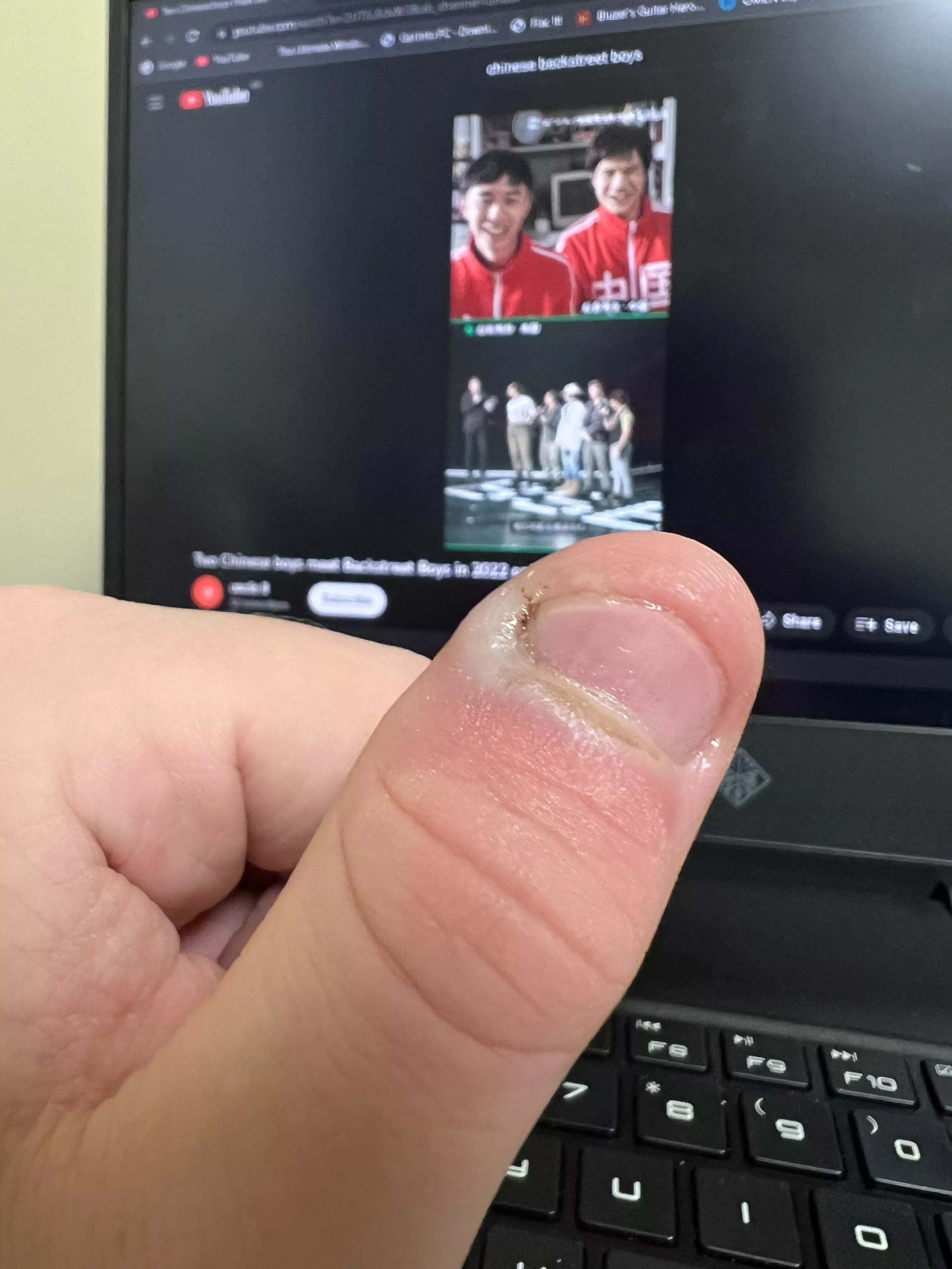 What is wrong with my thumb?!