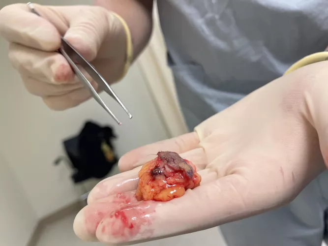 Had a cyst removed today.
