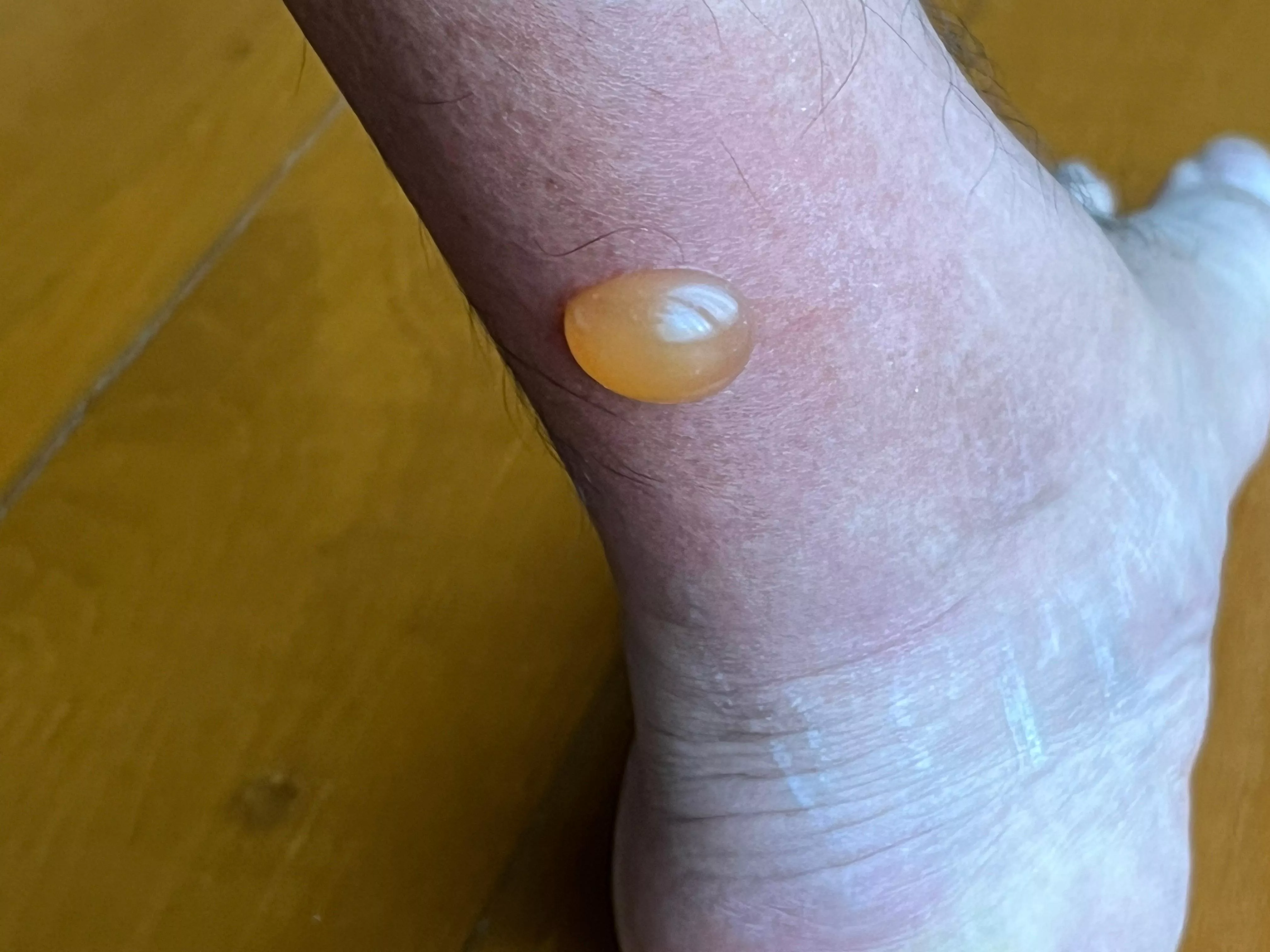 This mosquito bite reaction I currently have on my leg….