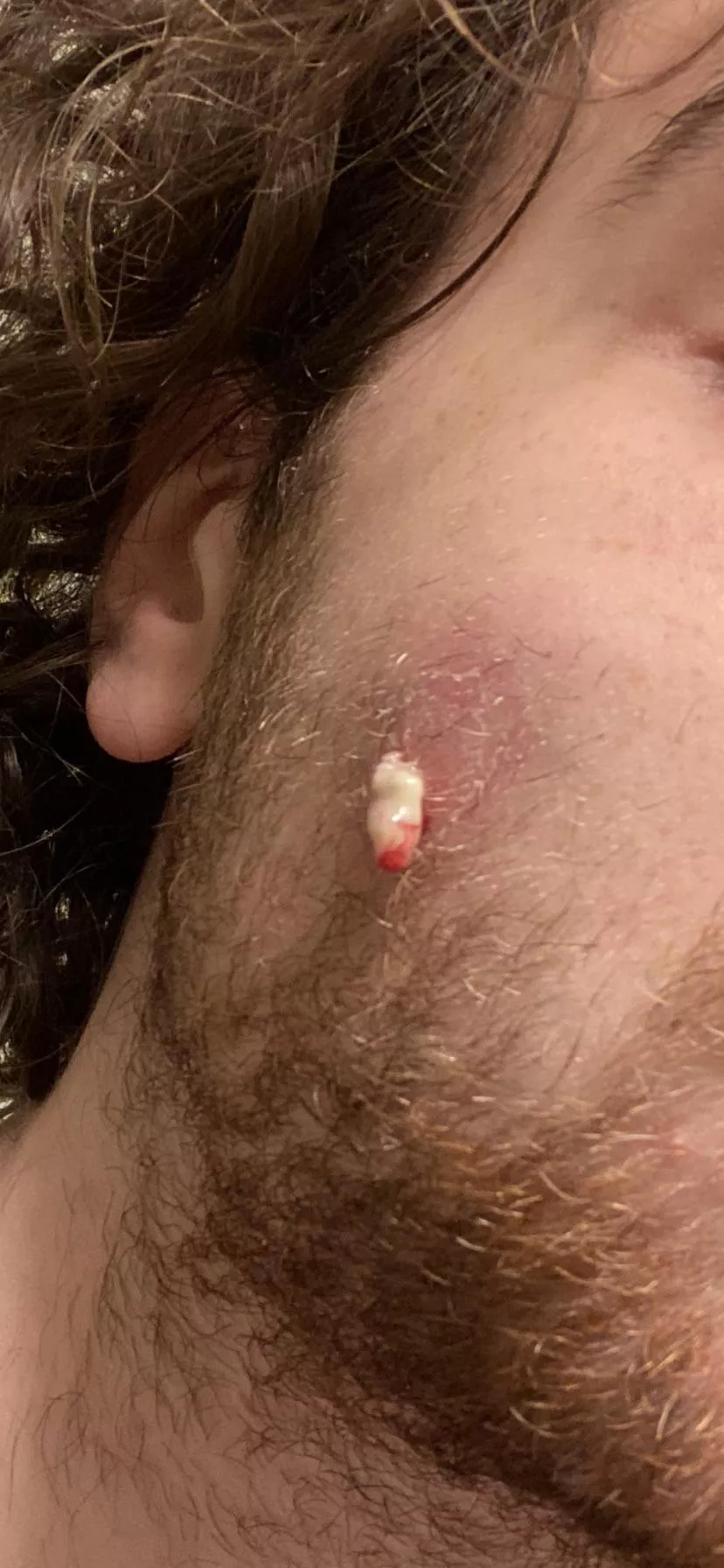 A stubborn pimple caused an infection the size of a golf ball in my cheek, almost spread to my sinus and eye. An IV and a few days of strong antibiotics later, the bastard finally showed itself