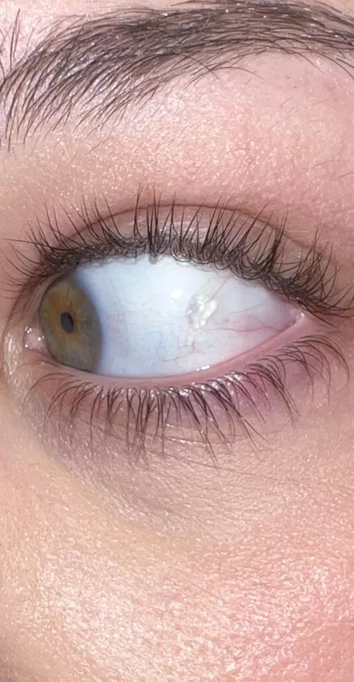 Anyone know what this squishy clear thing is on my eye?! Doctor dismissed it as nothing…?