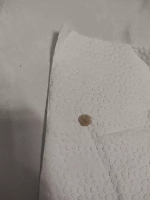 popping huge tonsil stone, wasn't able to record it