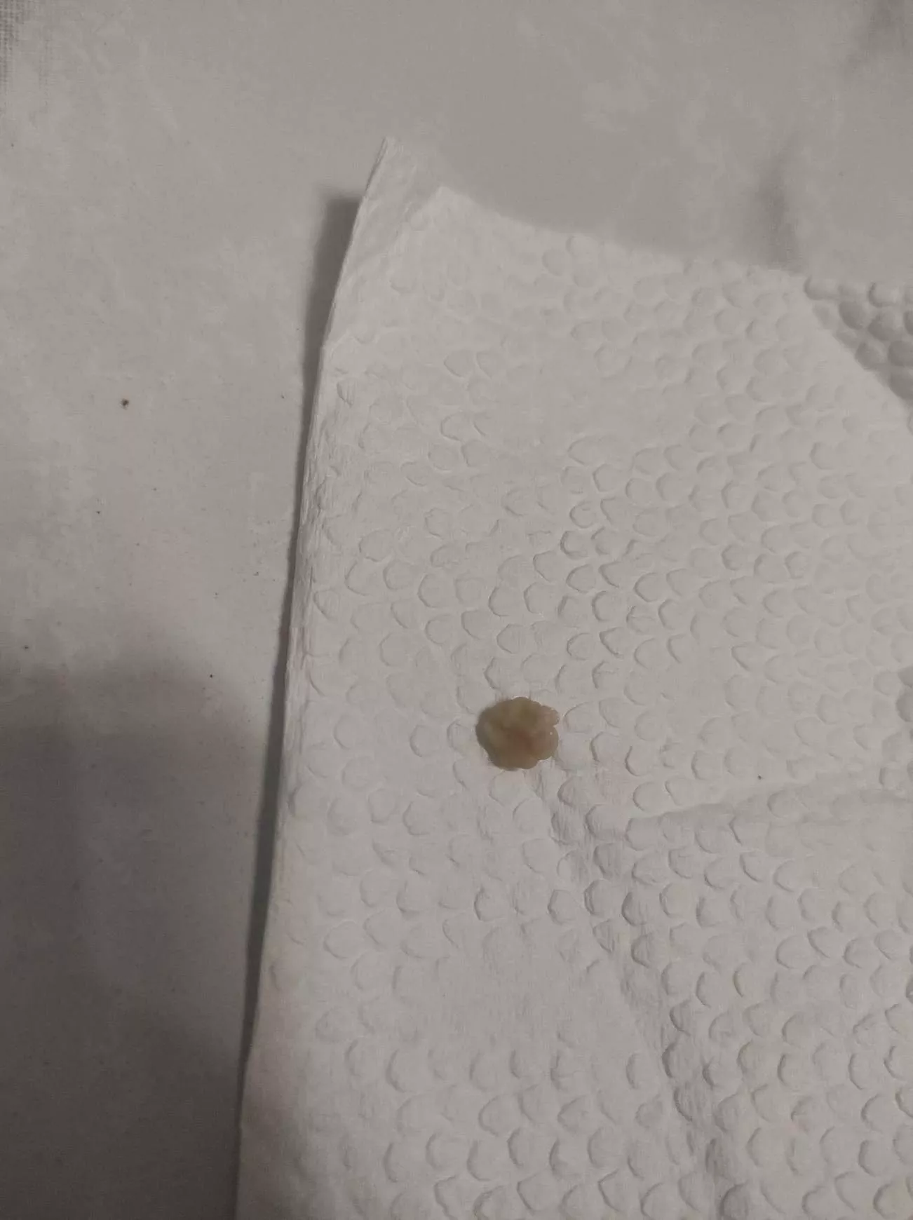 popping huge tonsil stone, wasn't able to record it