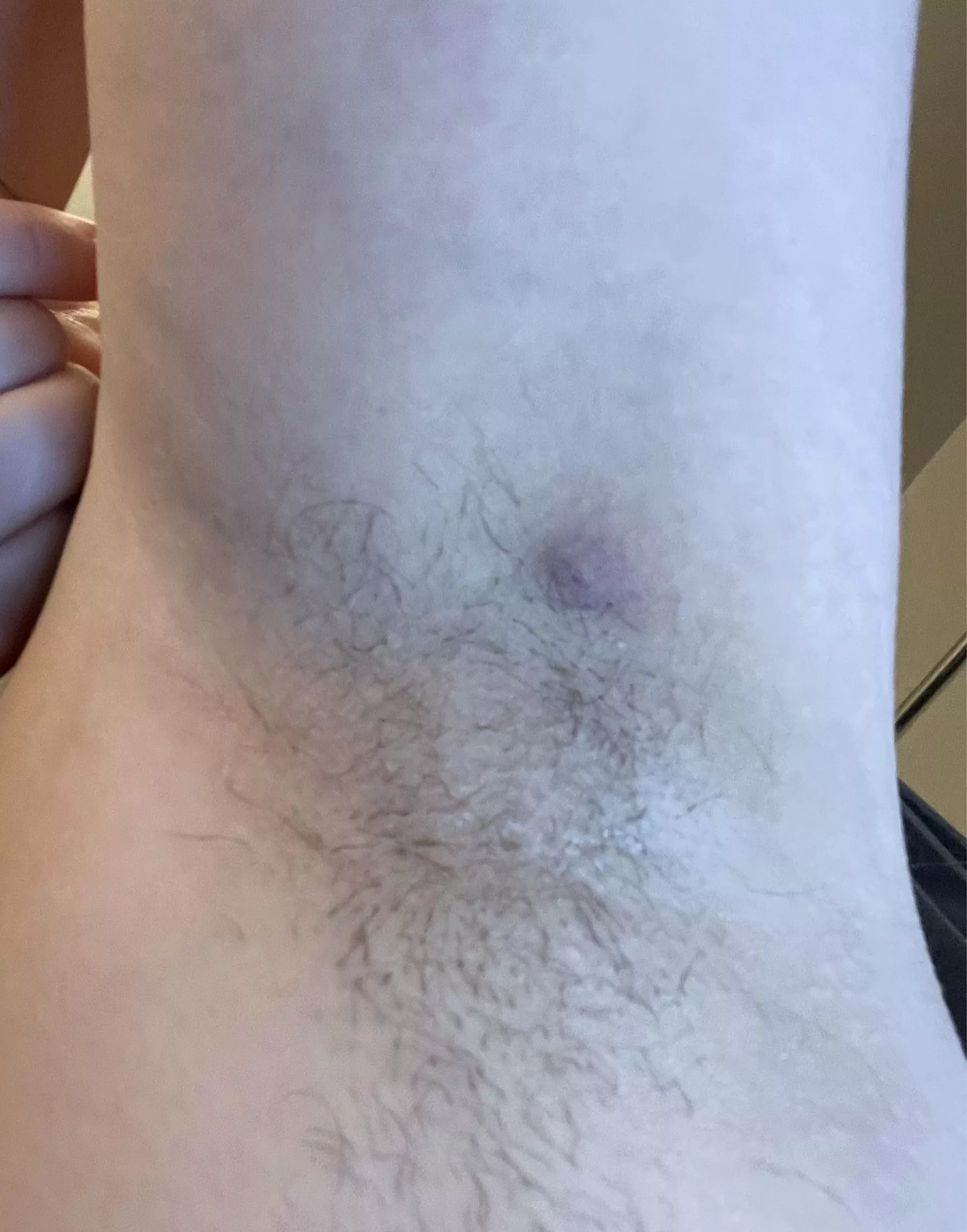 Thinking about trying to pop this awful (ingrown hair? boil?) in my armpit.