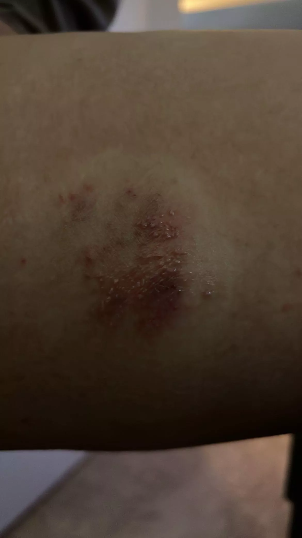 Wife has a rash and small bumps like blisters on her inner thigh. She's fighting the urge to start popping right now. Don't even know what it is though!