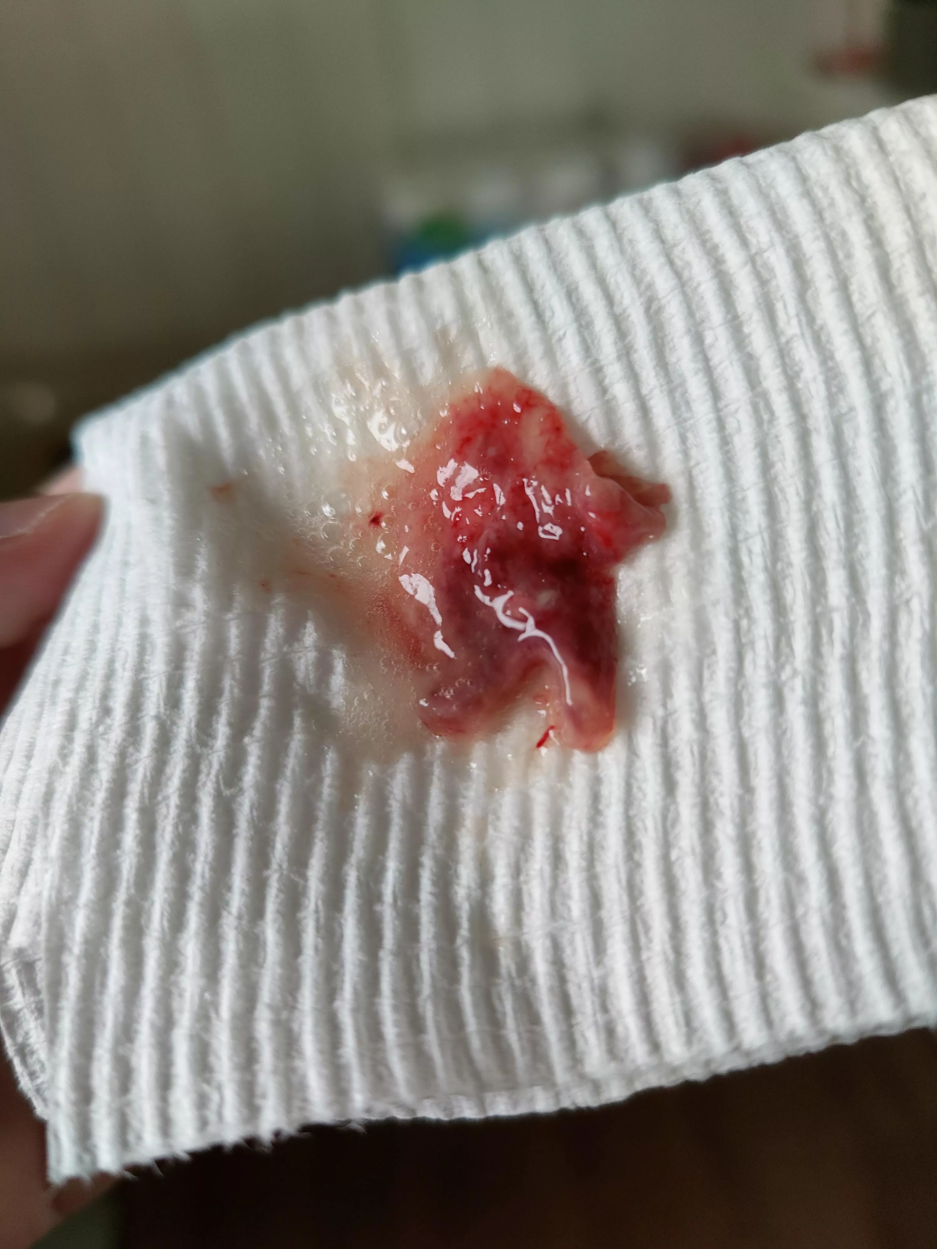 Coughing up phlem and this decided to violently come up.