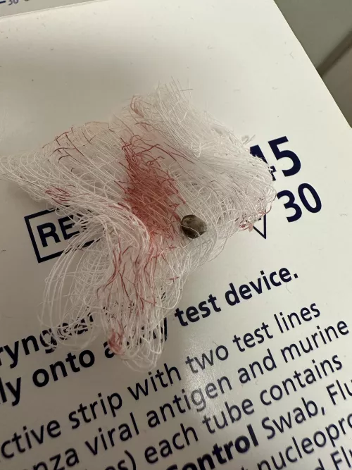 Removed this from an arm today
