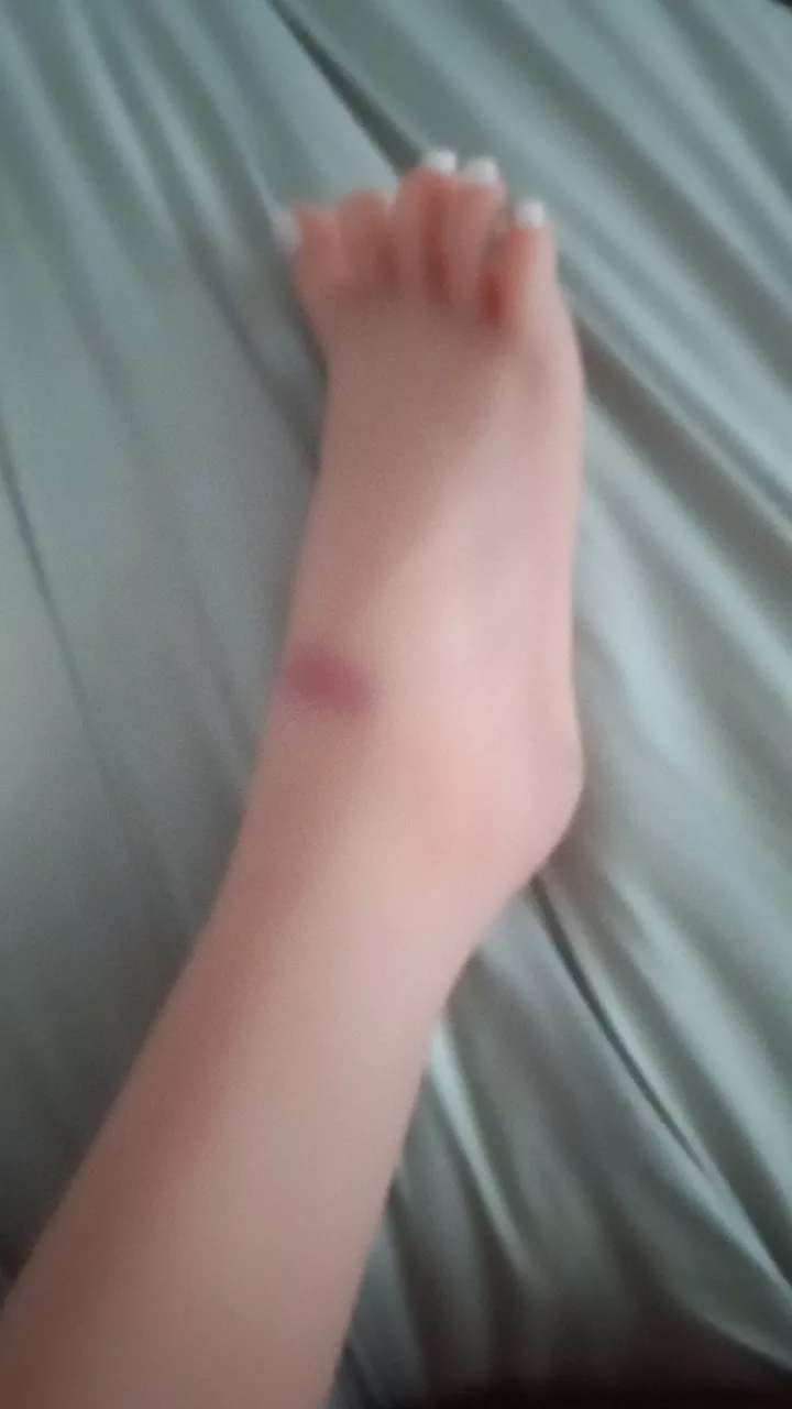 strange bruising on doll?