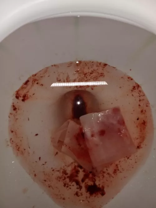 Update: Abcess burst, story in comments..including pic of the toilet immediately afterwards (bloody)