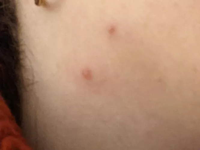 Angry pimple on neck