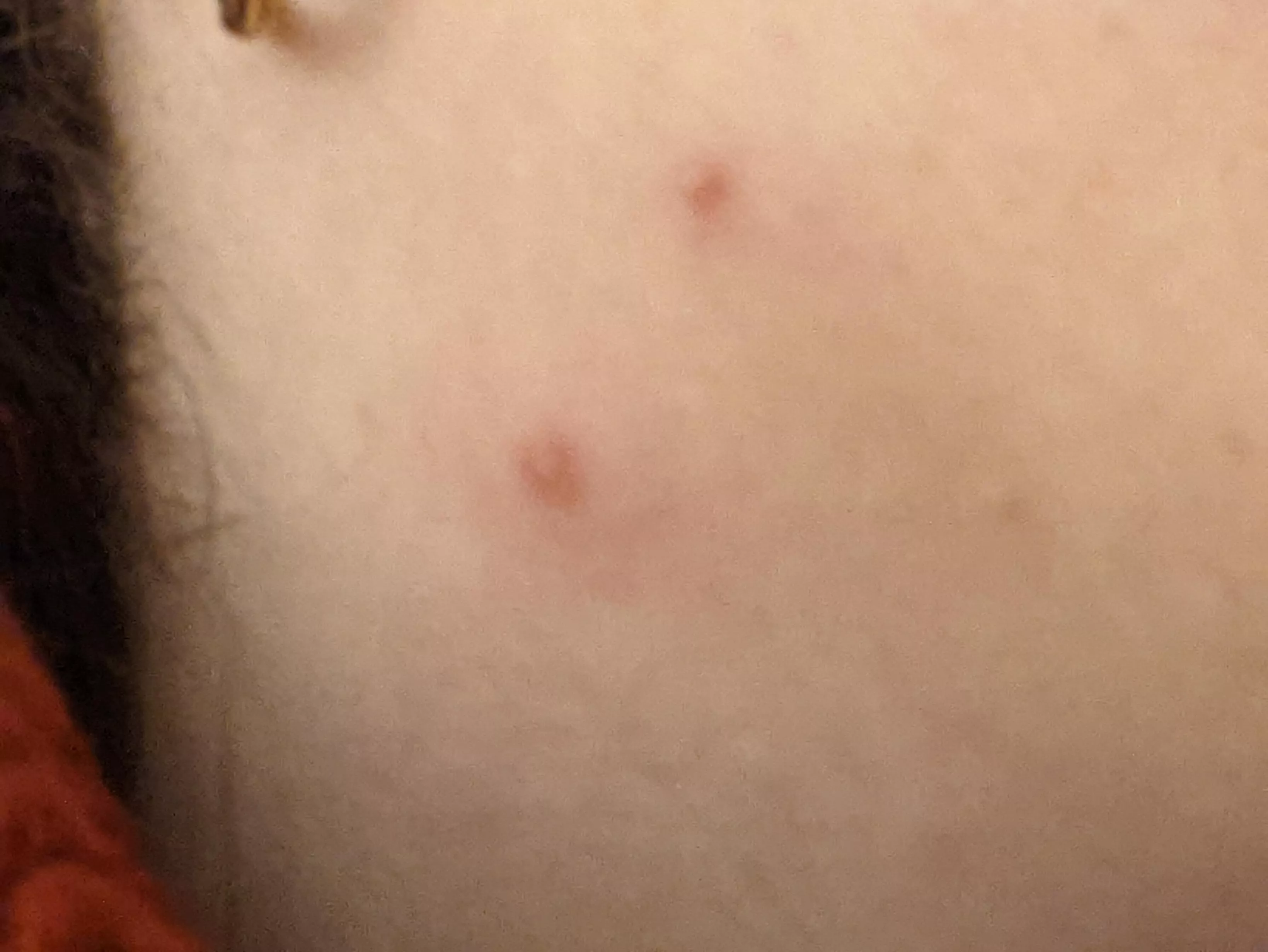 Angry pimple on neck