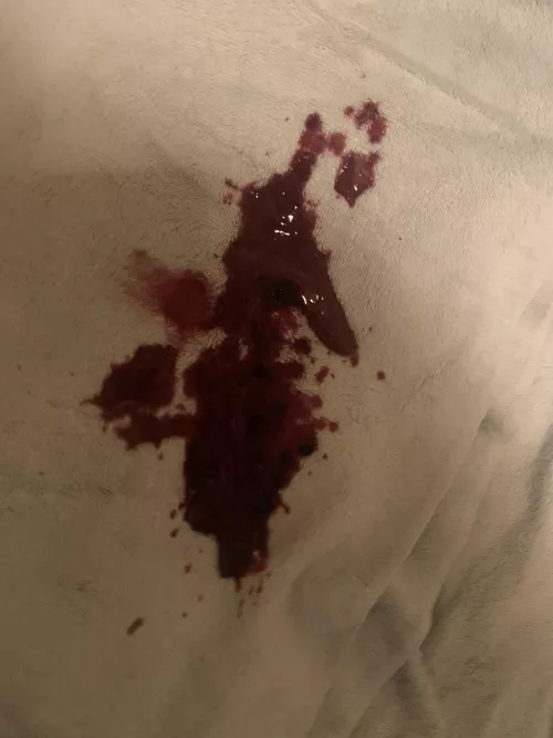 Had a boil on my waistline. Burst (semi) unexpectedly while on the toilet.