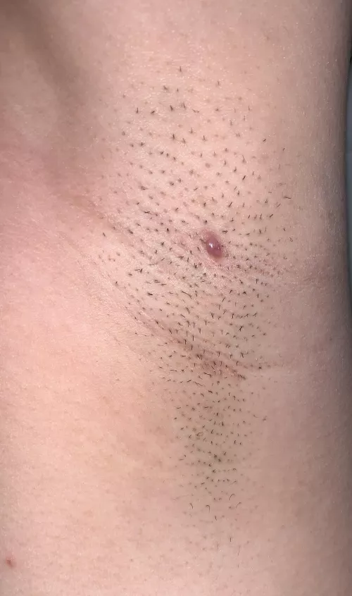 This appeared on my left armpit and I just found it today. I didn’t see it a few days when I shaved. It doesn’t rly hurt unless I mess with it, then it kinda hurts. I feel like it’s an ingrown hair but unsure.