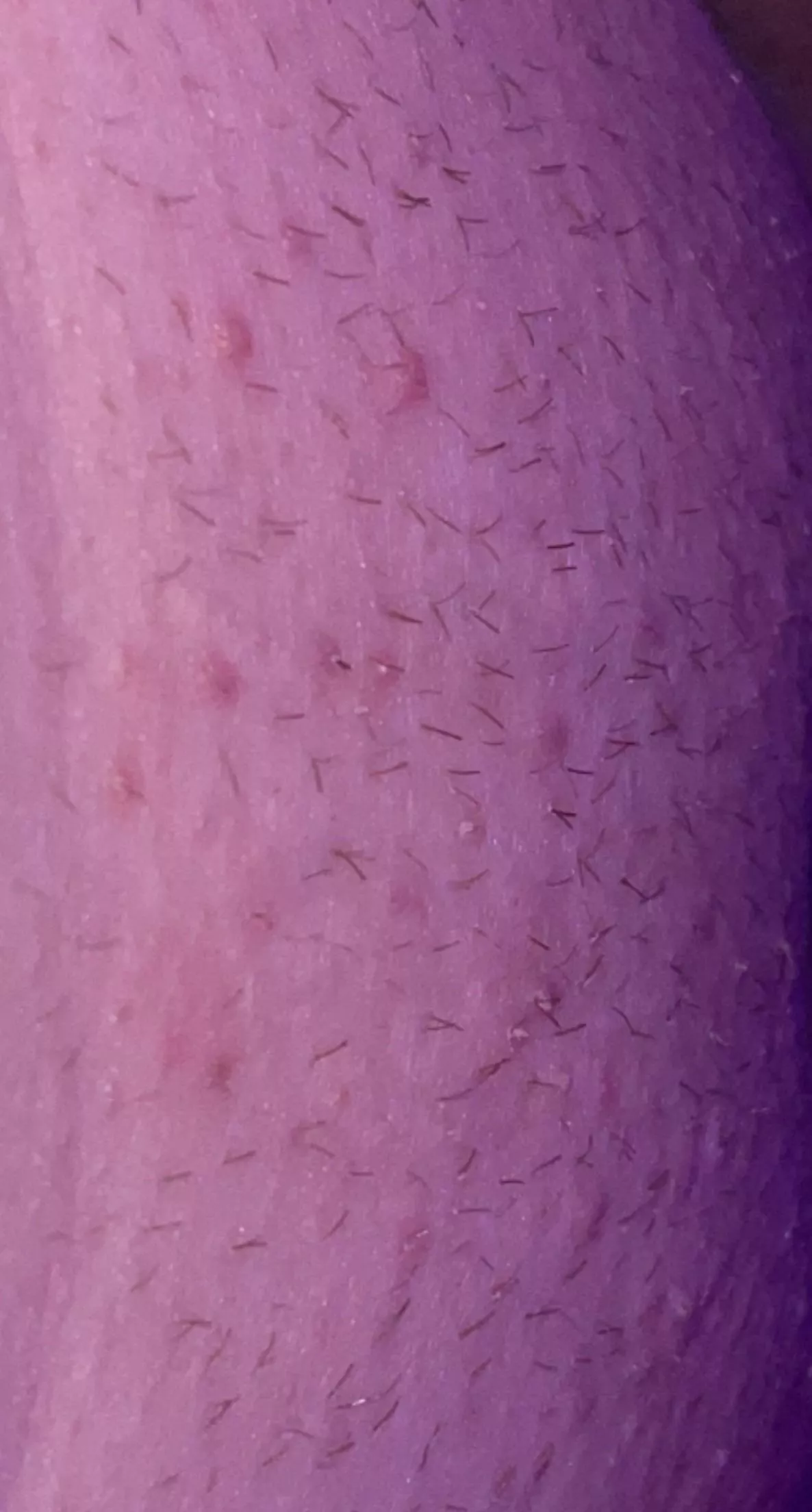 i literally don’t know what to do about razor bumps. i get ingrowns so easily too😩