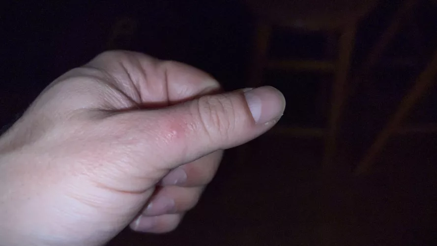 Woke up this morning with this weird zit on my thumb and popped it (ouch). Fast forward to tonight and it’s reared it’s head again 🫠