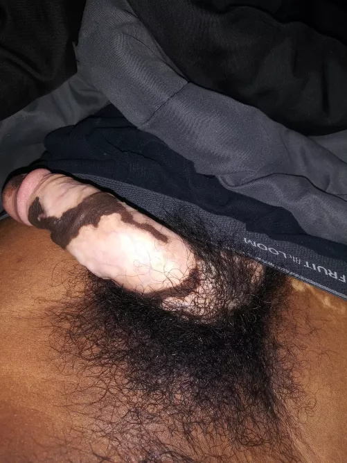 24 vitiligo full bush
