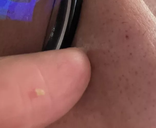 First time ever posting that came out of my husbands nose !