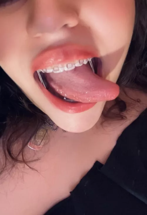 Getting these removed in 2 days!! 27F