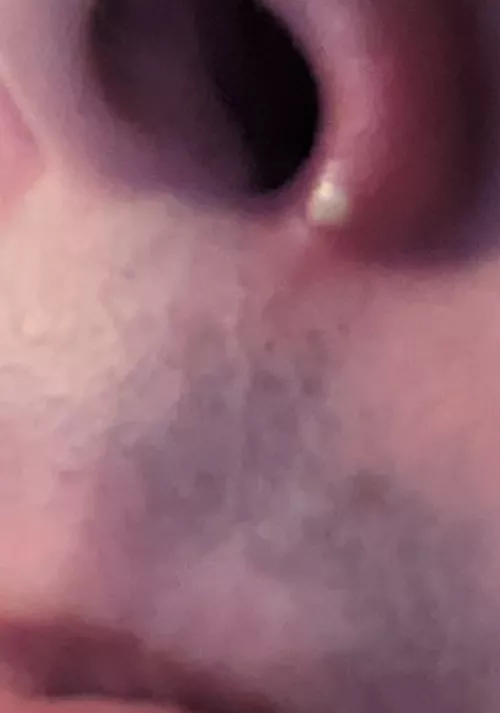 picking nostril scab, this appeared. cyst? do i go to doctor?