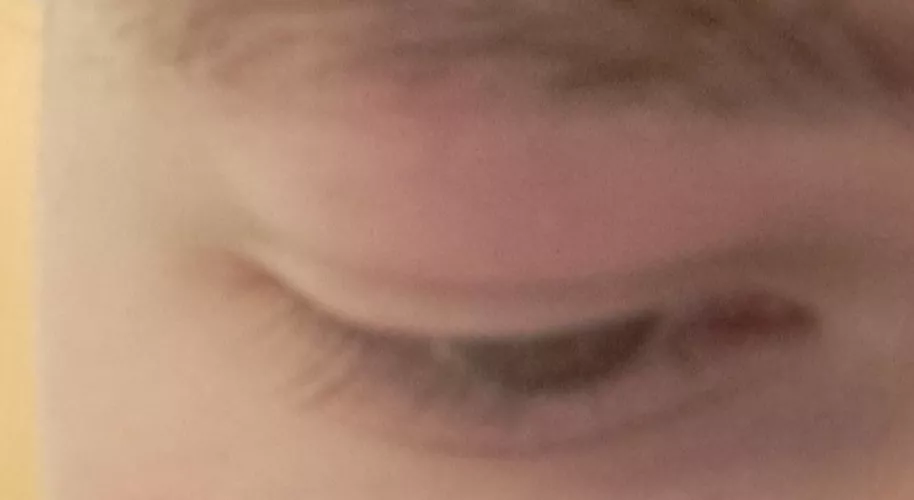 popped a pimple on my eyebrow, now it got swollen and it's pushing down on my eye. it's kind of red too, but it's not painful