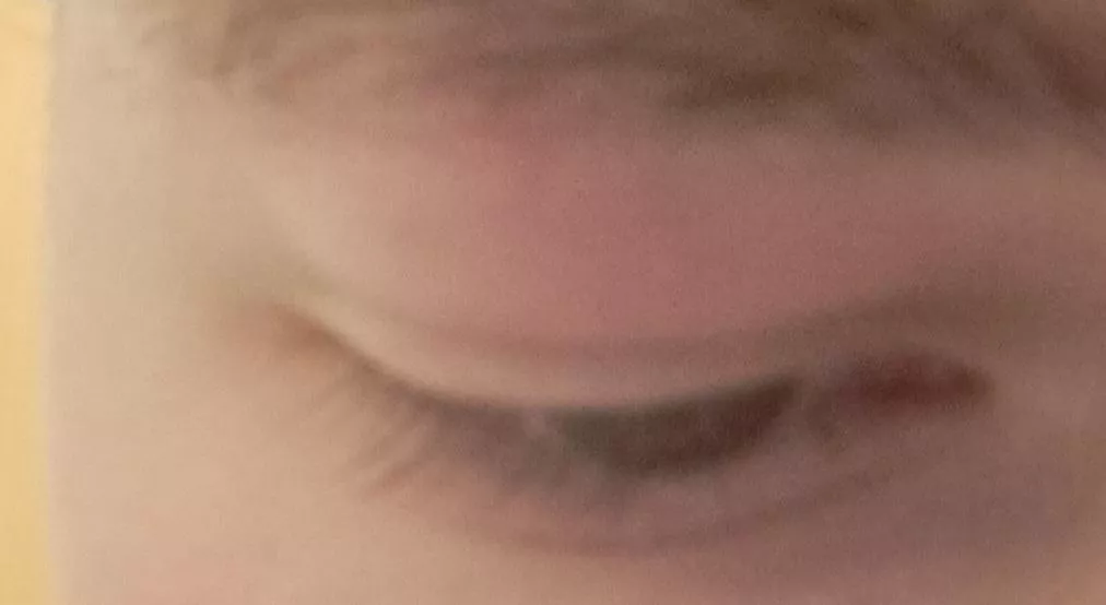 popped a pimple on my eyebrow, now it got swollen and it's pushing down on my eye. it's kind of red too, but it's not painful