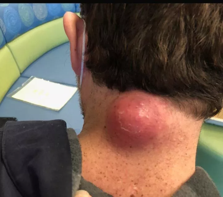 My infected cyst. I had it removed last week. it hurt so much.