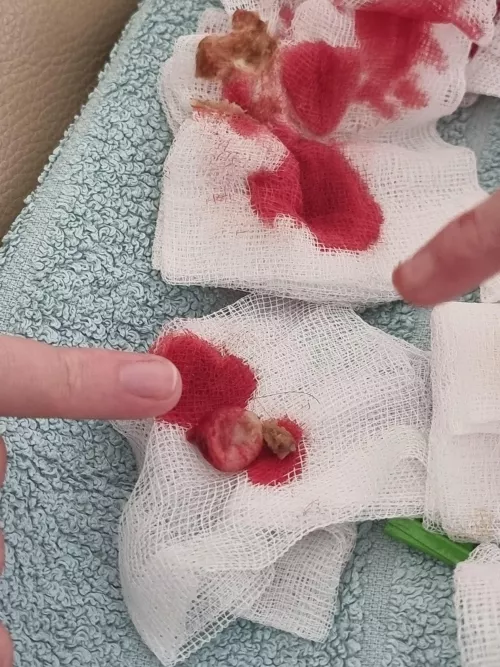 SO removed a 10 year old pilar cyst