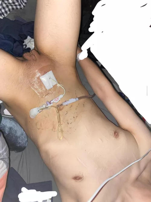 M, 26, 130, 5’6 - micropenis causes issues with urethra, going back into surgery tomorrow