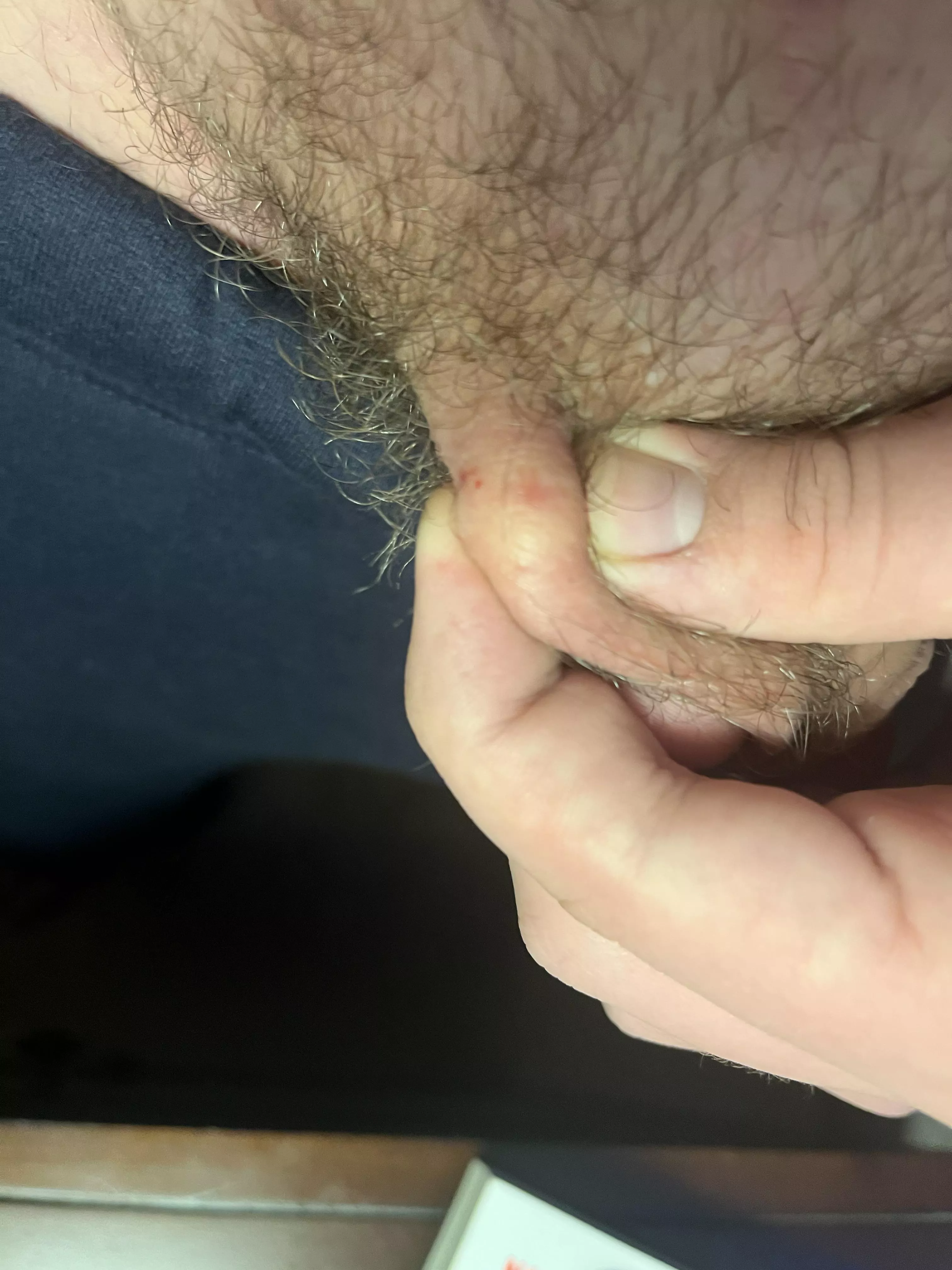 Does anyone know what this is? I've had it for a year now. It's under the skin, and it's leathery and thick on top. I feel like it's a cyst, but just want confirmation.