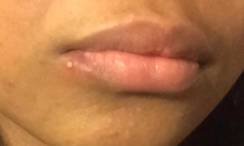 Horrid little thing on my bottom lip I popped it yesterday and now it’s huge and more painful