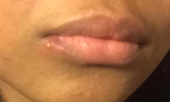 Horrid little thing on my bottom lip I popped it yesterday and now it’s huge and more painful