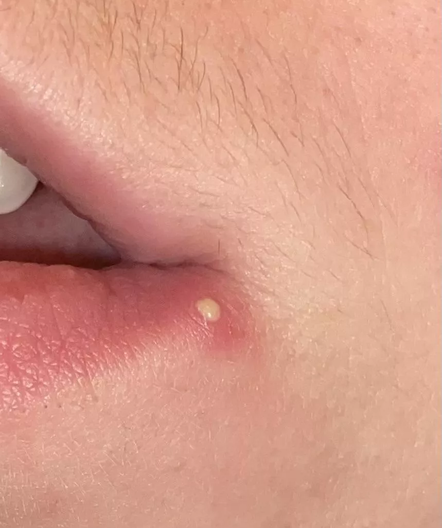 I’m 5 months on Testosterone and getting some killer spots 💀 this one hurt so bad but was delightful to pop, apologies for no video!!