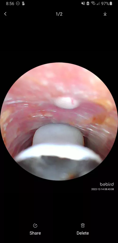 My ear was itching like crazy, so I looked and found an ear pearl. It was kinda squishy.