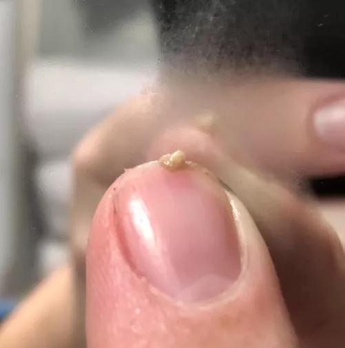 Quite a small harvest from squeezing all the blackheads on my nose. If I am disciplined and don’t touch it for a few weeks, the pile of gunk is even bigger after smearing all the blackhead gunk together.